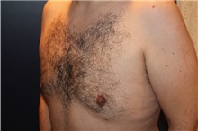 gynecomastia after image gynecomastia after image