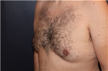 gynecomastia before image gynecomastia before image