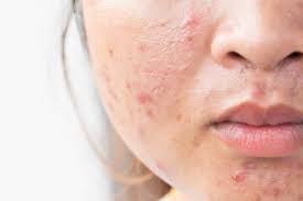 scar reduction treatment in delhi
