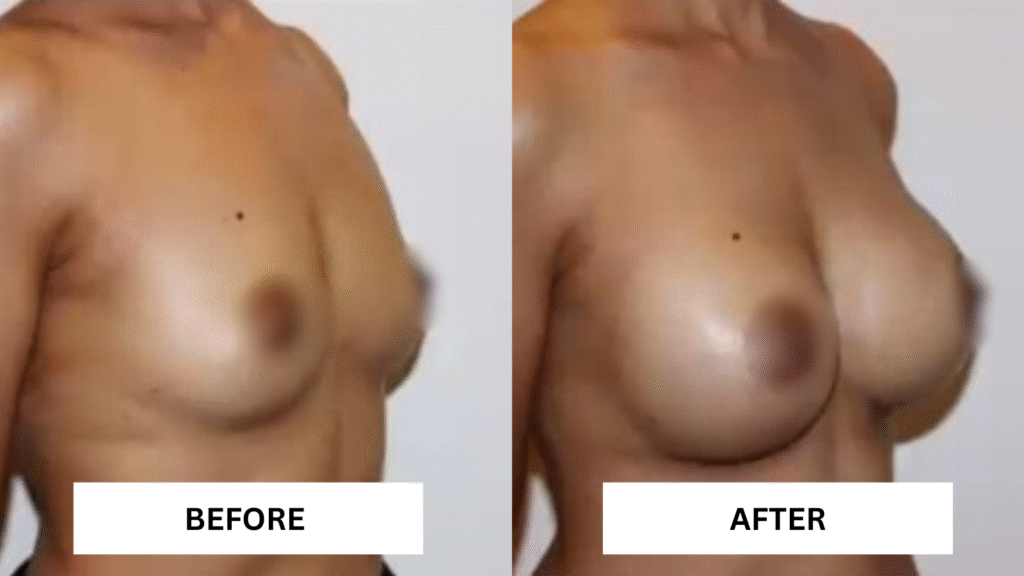 Breast Augmentation Before and After Photo