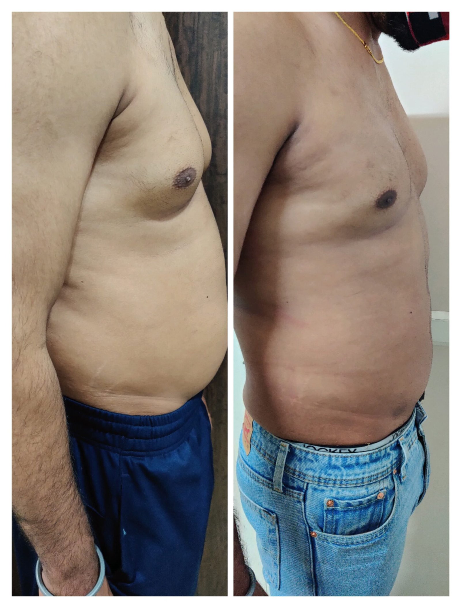gynecomastia surgery cost in delhi