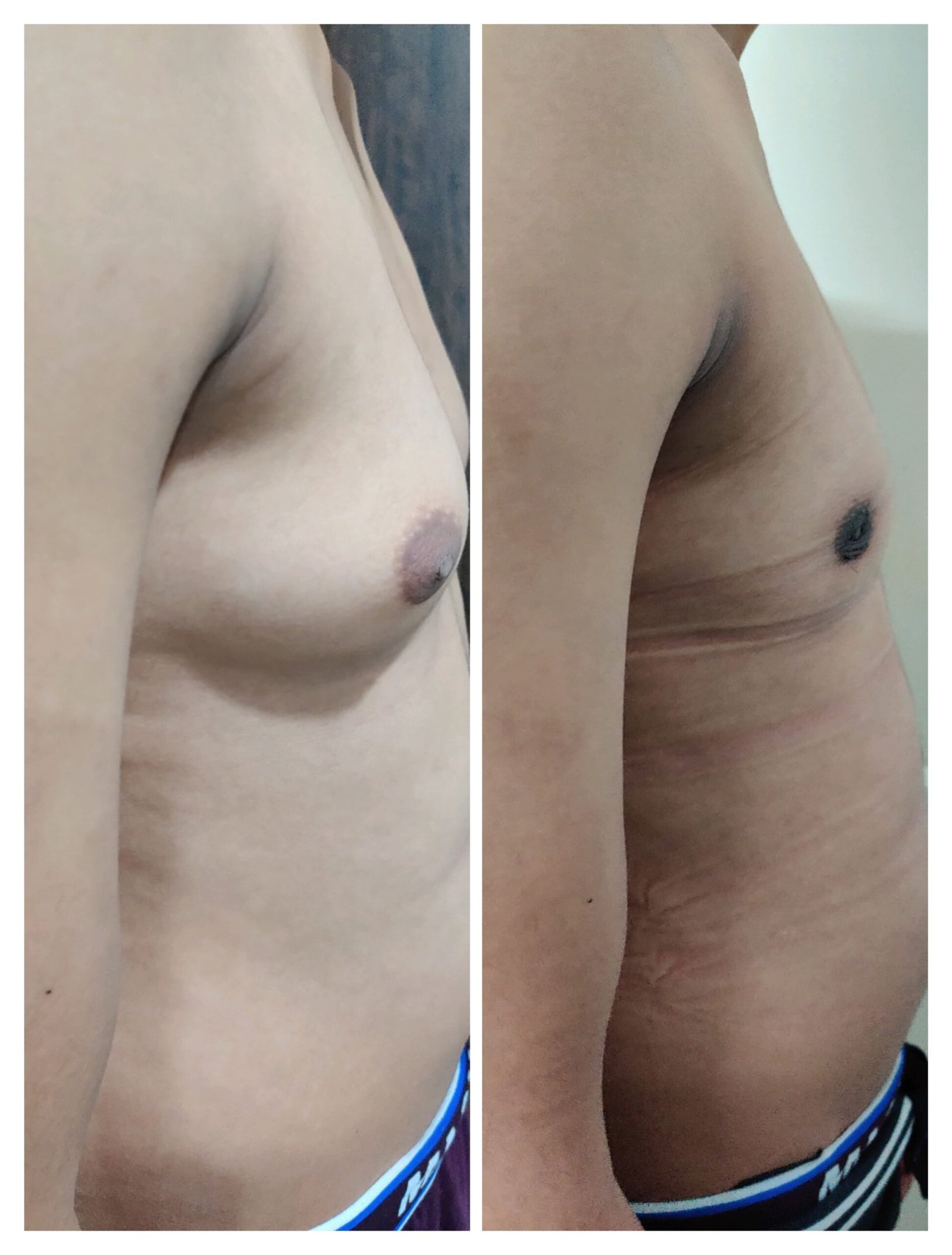 gynecomastia surgery in Noida