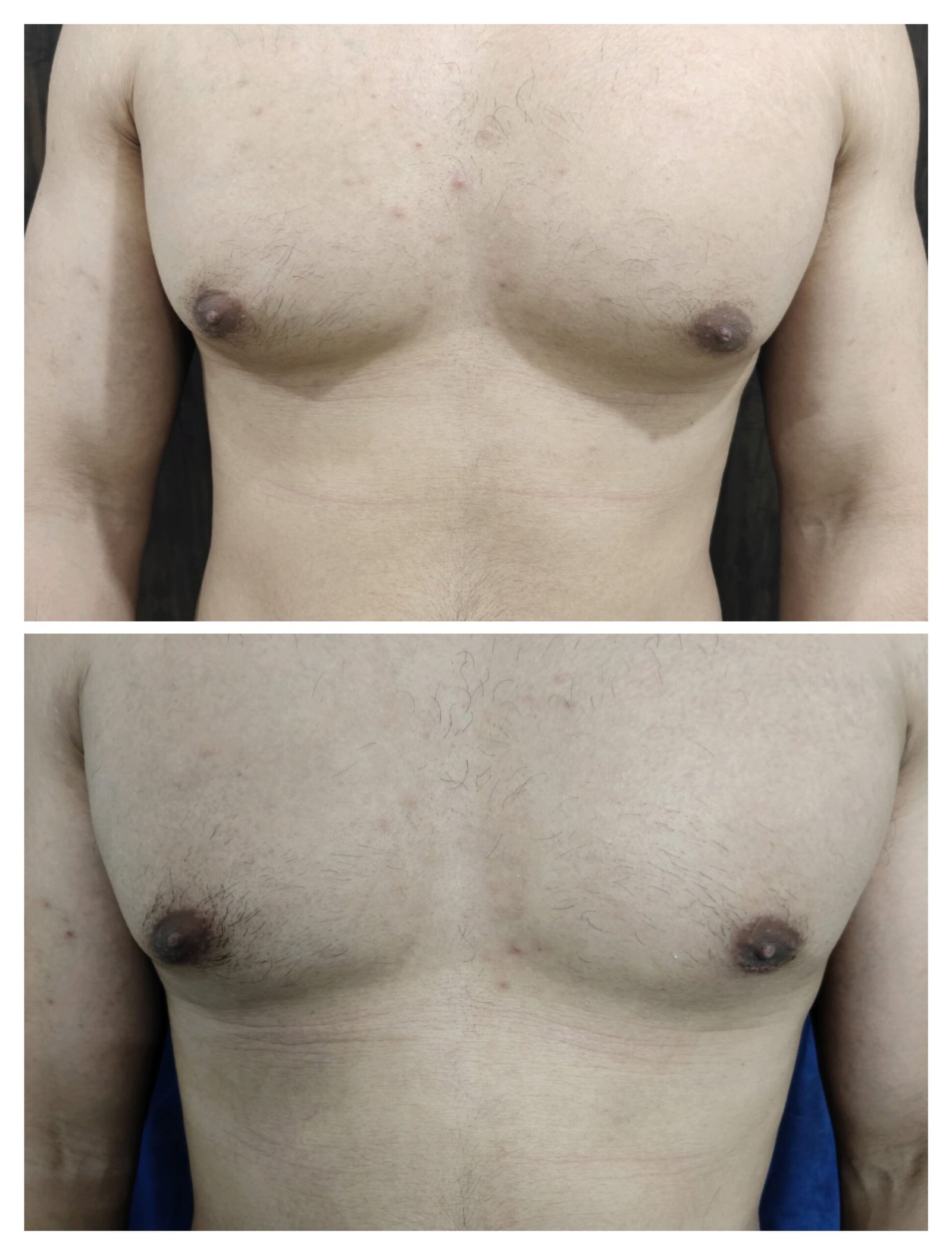 gynecomastia surgery in delhi, India