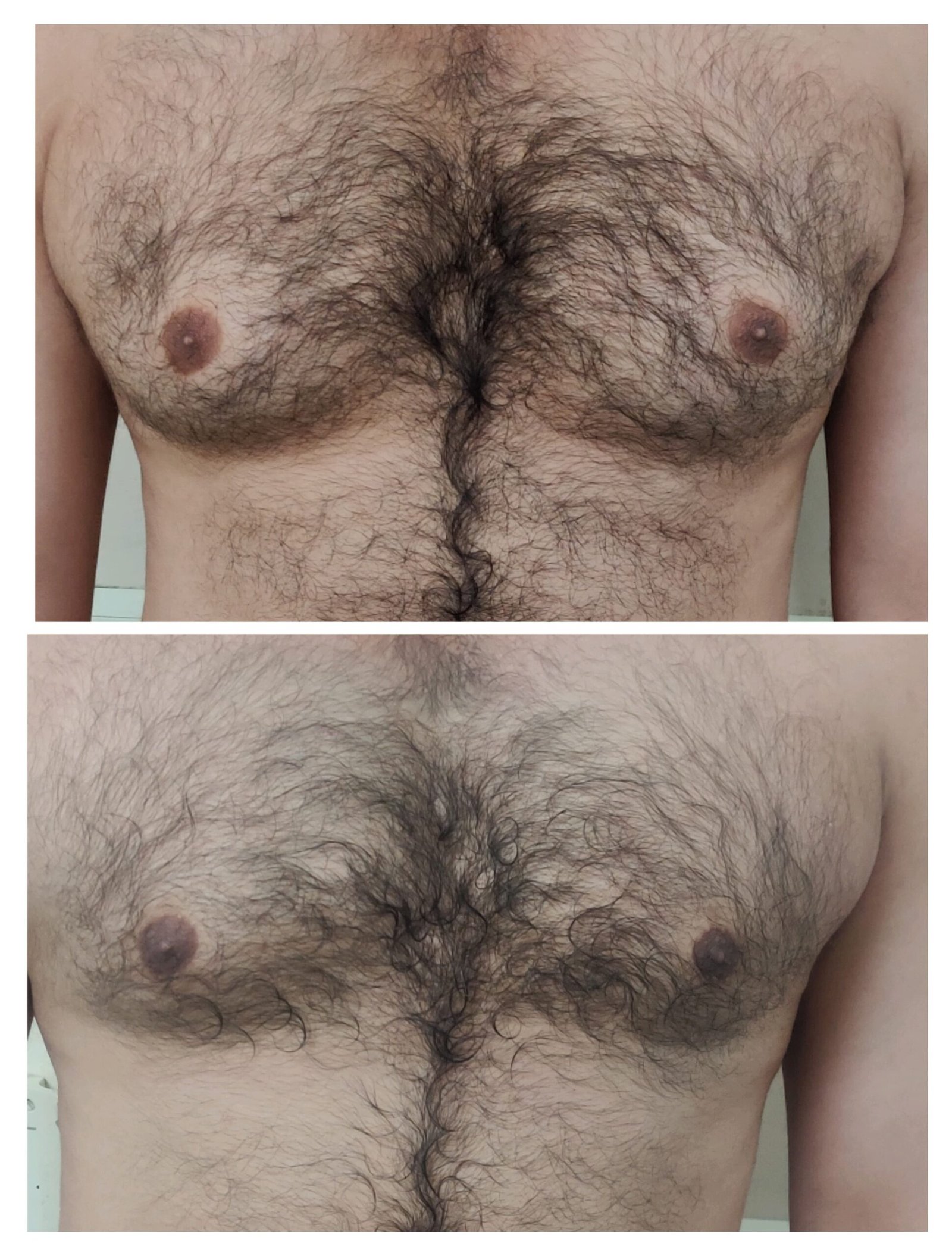 gynecomastia surgery photos