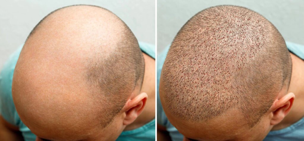 Hair Transplant in Delhi, India