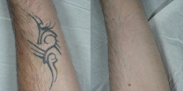 Tattoo Removal Before And After Pictures